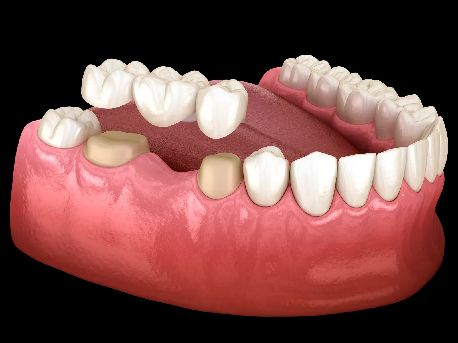 Dental Crowns at Flossophy Dental Studio Matthew