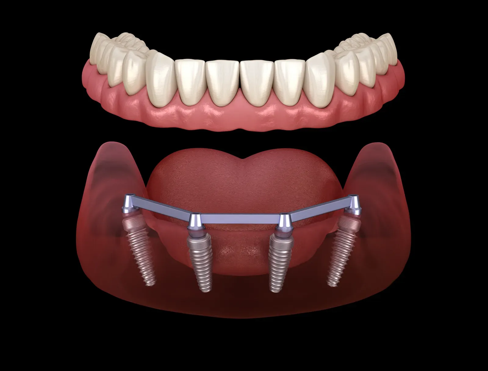 Dental Implant at Flossophy Dental Studio Matthew