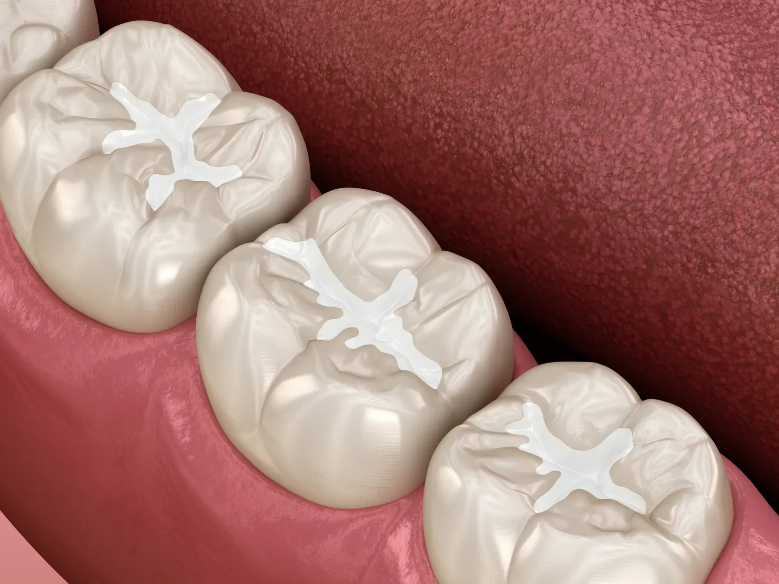 Dental Sealants at Flossophy Dental Studio Matthew